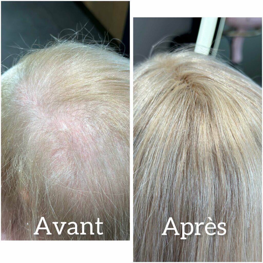 Micro Line, traitement pour cheveux clairsemés