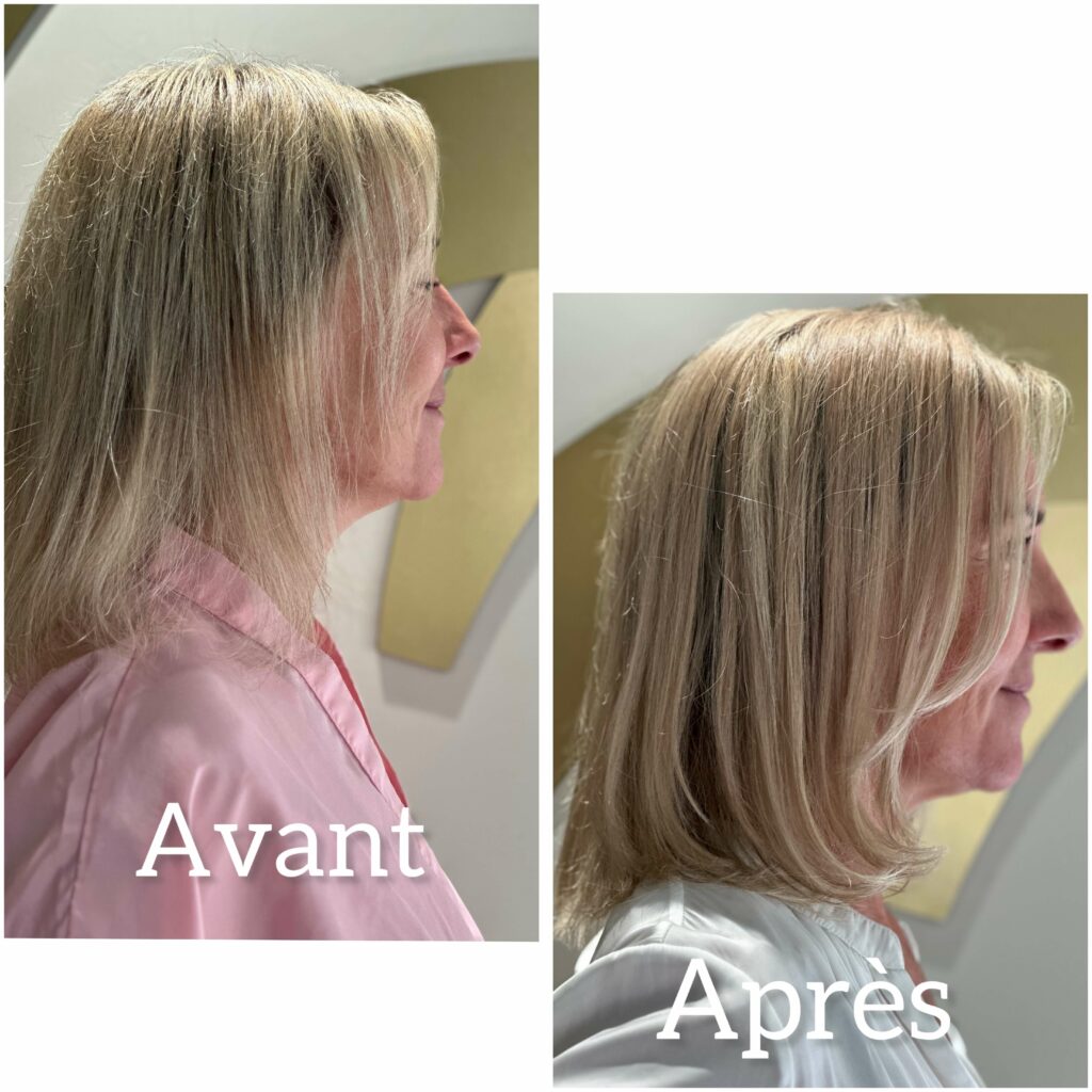 Micro Line, traitement pour cheveux clairsemés