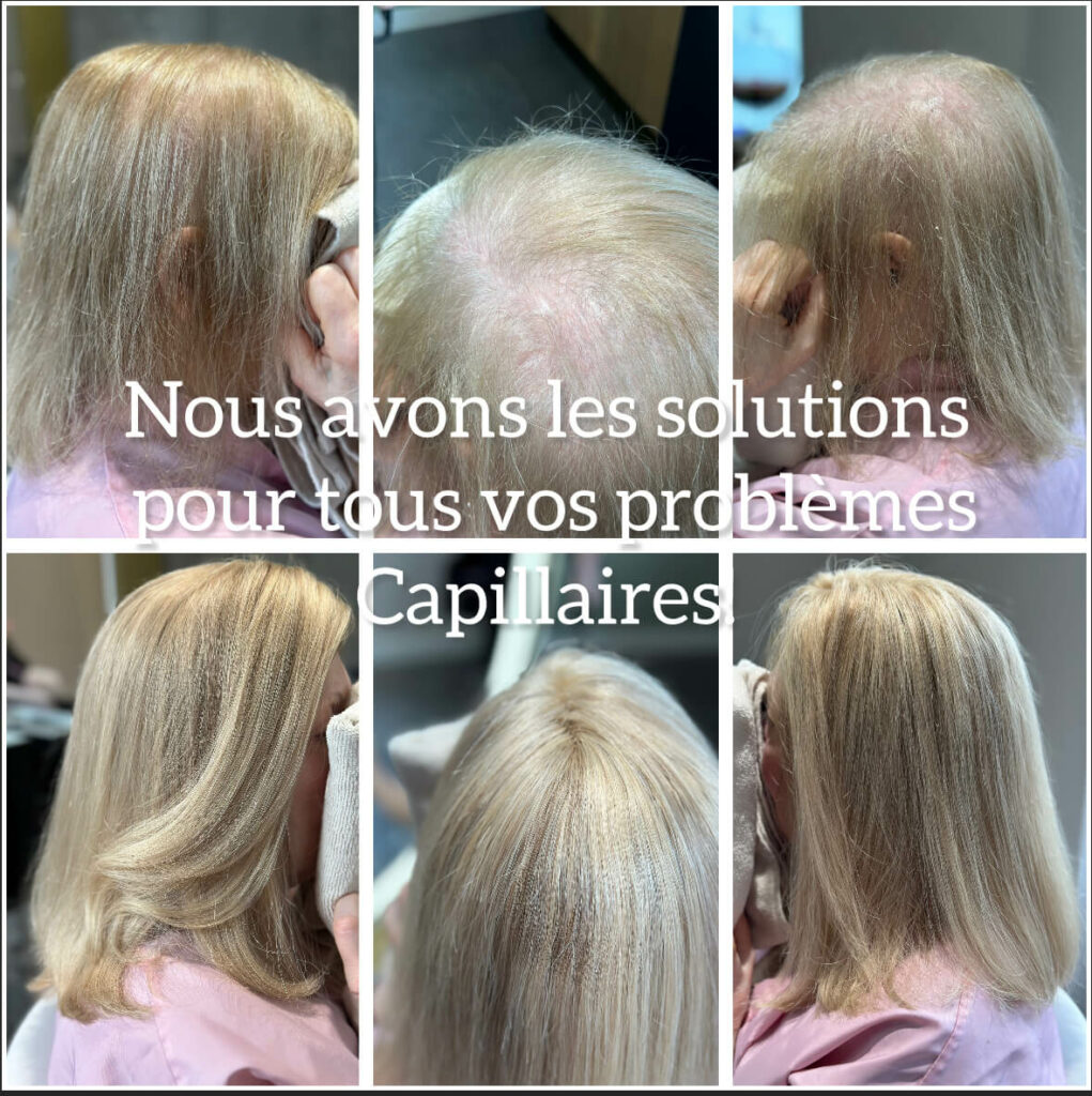 Micro Line, traitement pour cheveux clairsemés