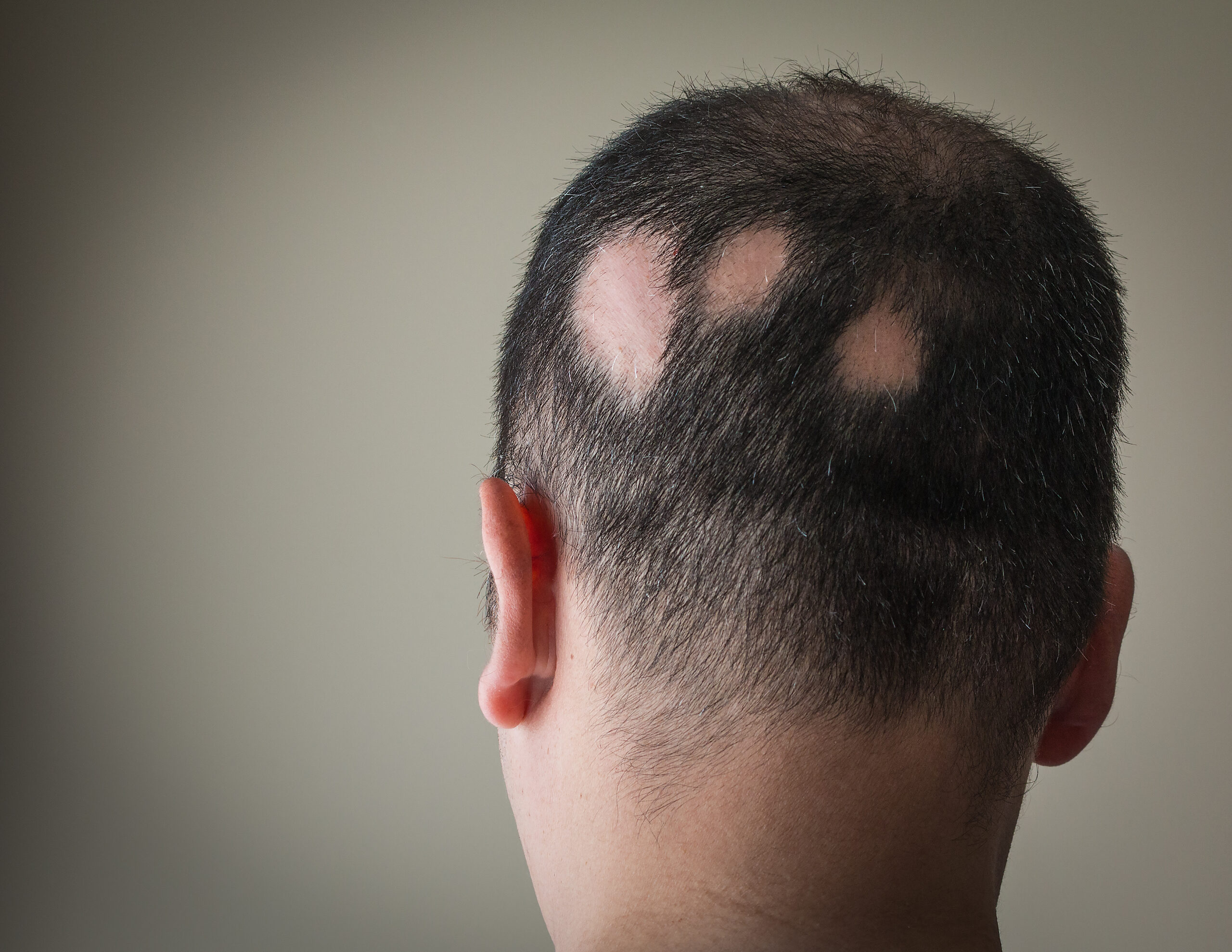 Traitement pelade Strasbourg, salon de coiffure strasbourg