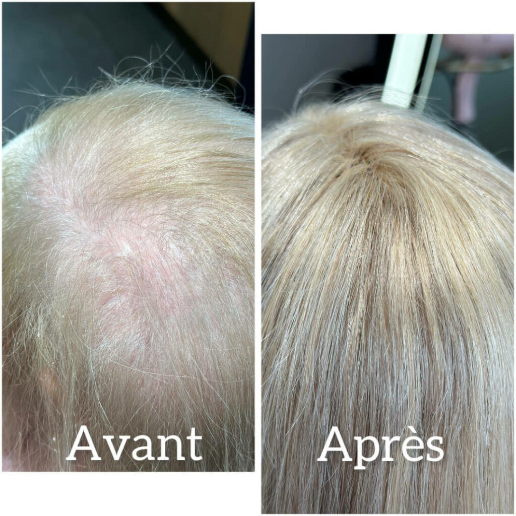 dites stop aux cheveux fins et au crane visible pour une femme