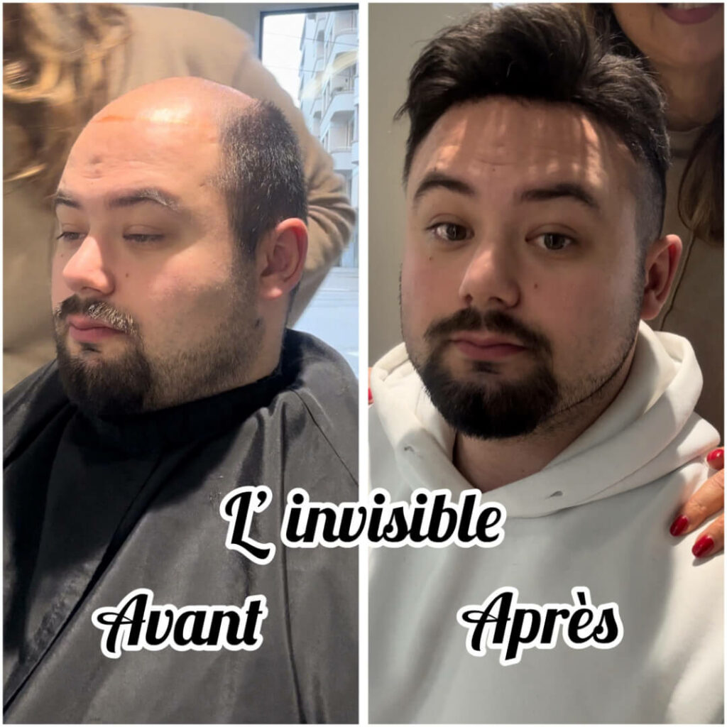 grosse calvitie decouvrez la solution invisible qui va vous changer la vie