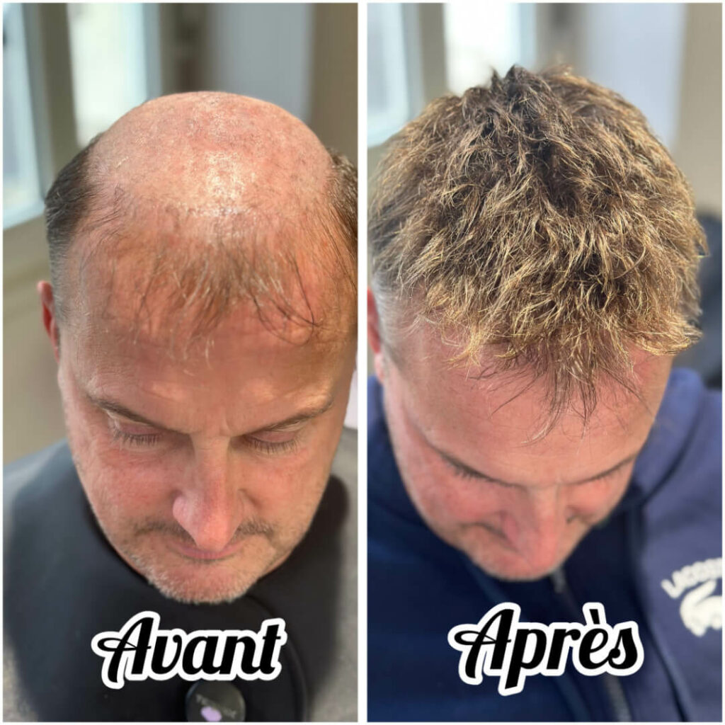 prothese capillaire a strasbourg quelles solutions innovantes contre la perte de cheveux