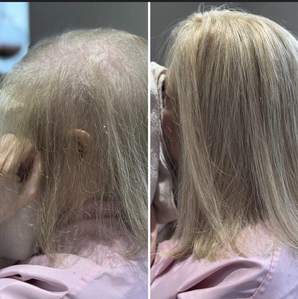 traitement pour la perte de cheveux - albres contades strasbourg